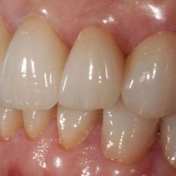 e-max_veneers_20
