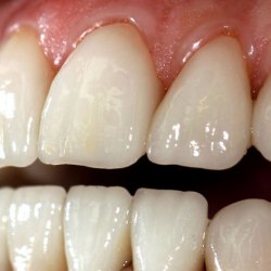 e-max_veneers_21