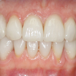 e-max_veneers_23