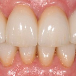 e-max_veneers_24