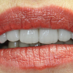 e-max_veneers_26