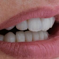 e-max_veneers_28