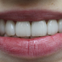 e-max_veneers_29