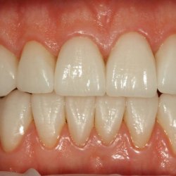 e-max_veneers_34