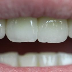 e-max_veneers_36