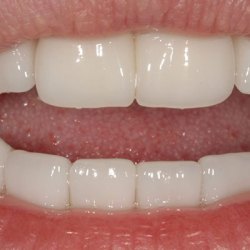 e-max_veneers_37