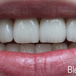e-max_veneers_39