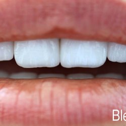 e-max_veneers_41