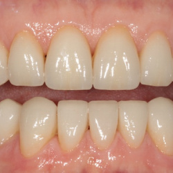 e-max_veneers_43