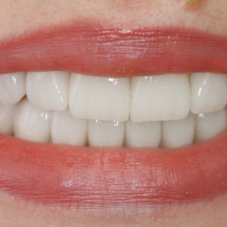 e-max_veneers_44