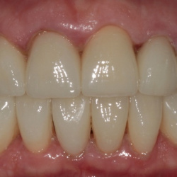 e-max_veneers_45