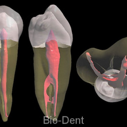 microscopic-root-canal-treatment-02