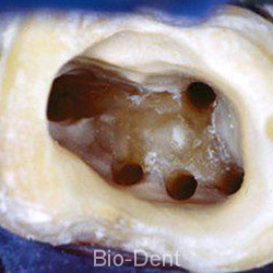 microscopic-root-canal-treatment-03