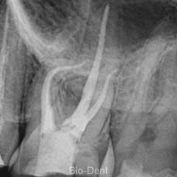 microscopic-root-canal-treatment-04