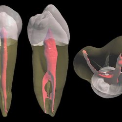 microscopic-root-canal-treatment-02