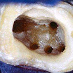 microscopic-root-canal-treatment-03