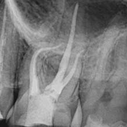 microscopic-root-canal-treatment-04