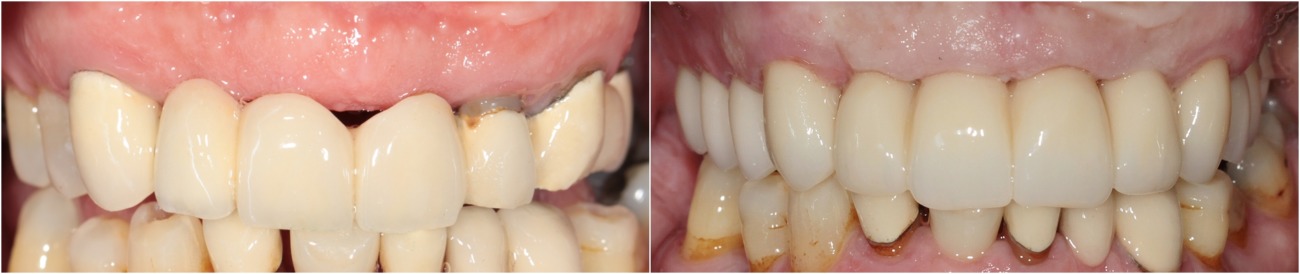 Имплантация зубов без разреза - 01