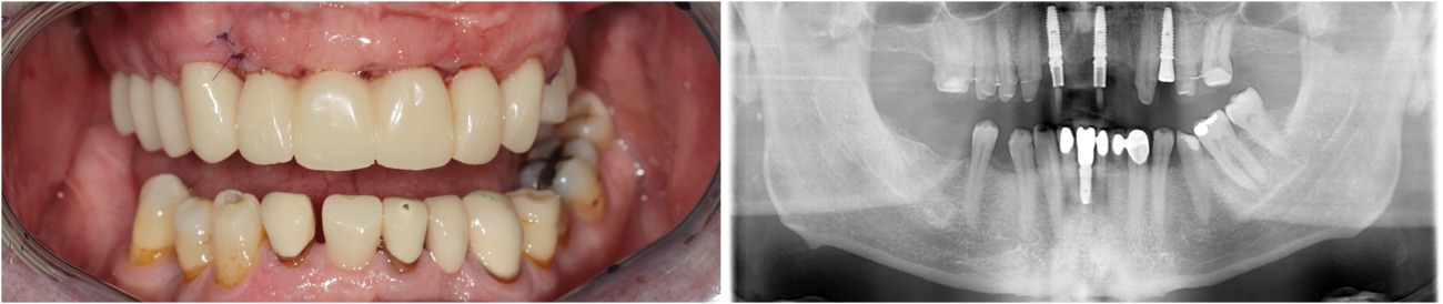 Имплантация зубов без разреза - 02