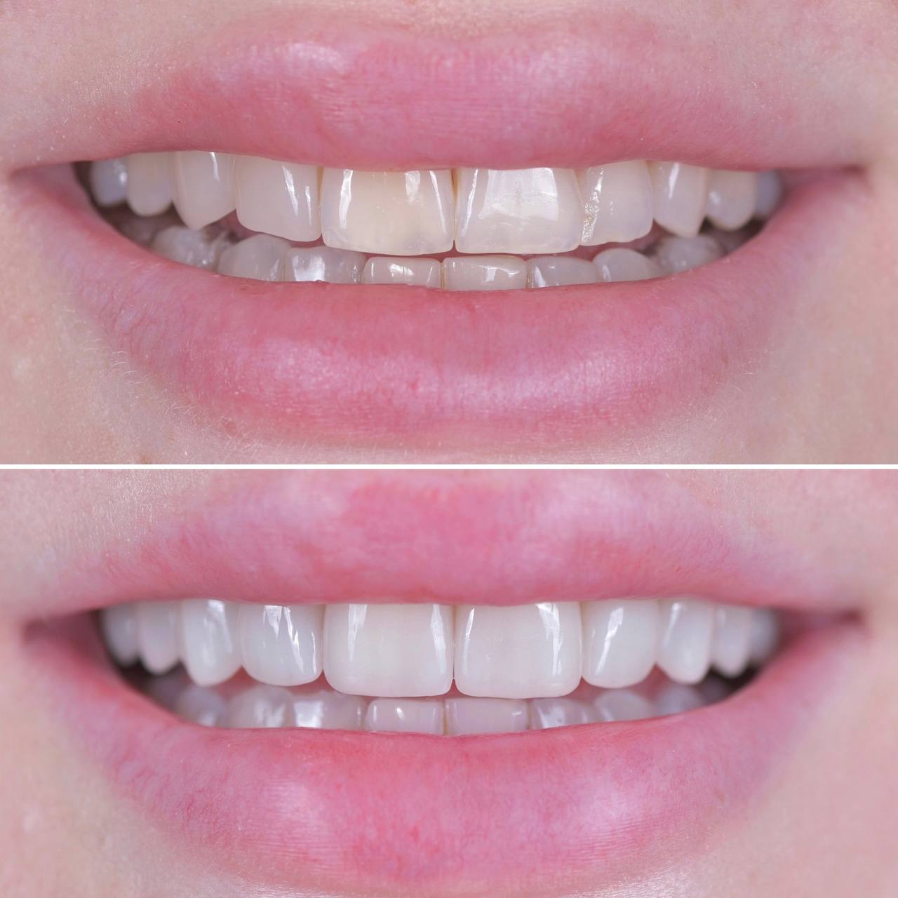 14 ceramic veneers and overlays on the upper jaw in B1