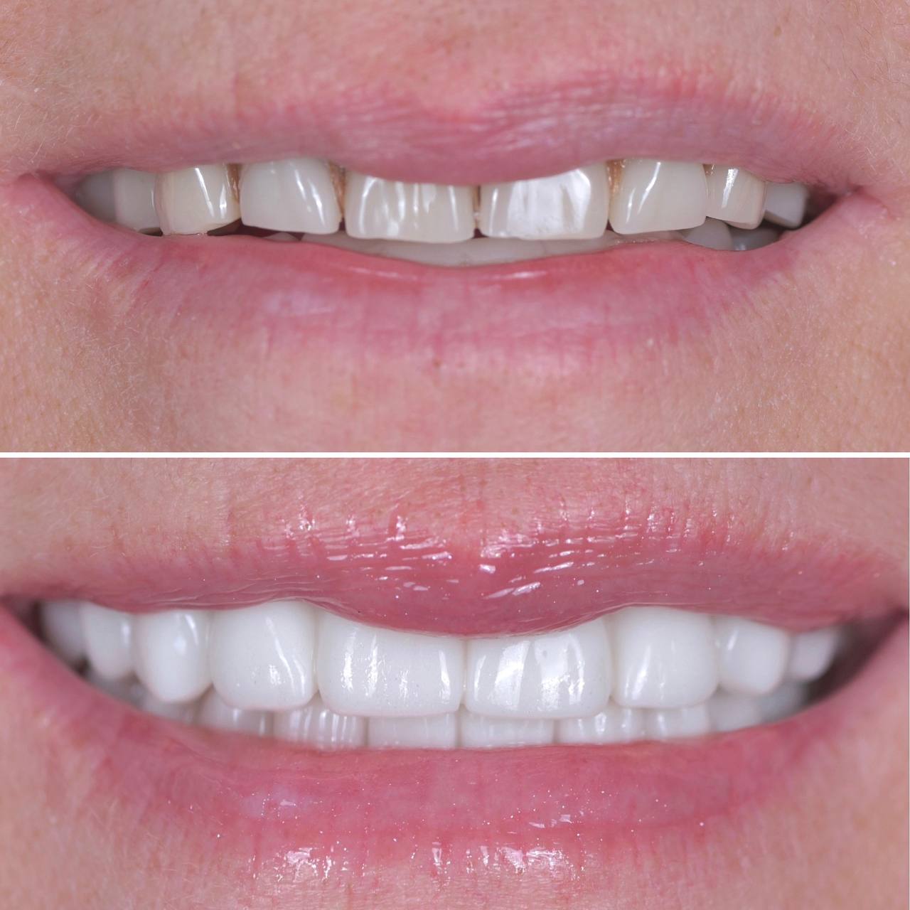 Biopolymer bridges All-on-4 on a titanium bar for the upper and lower jaw